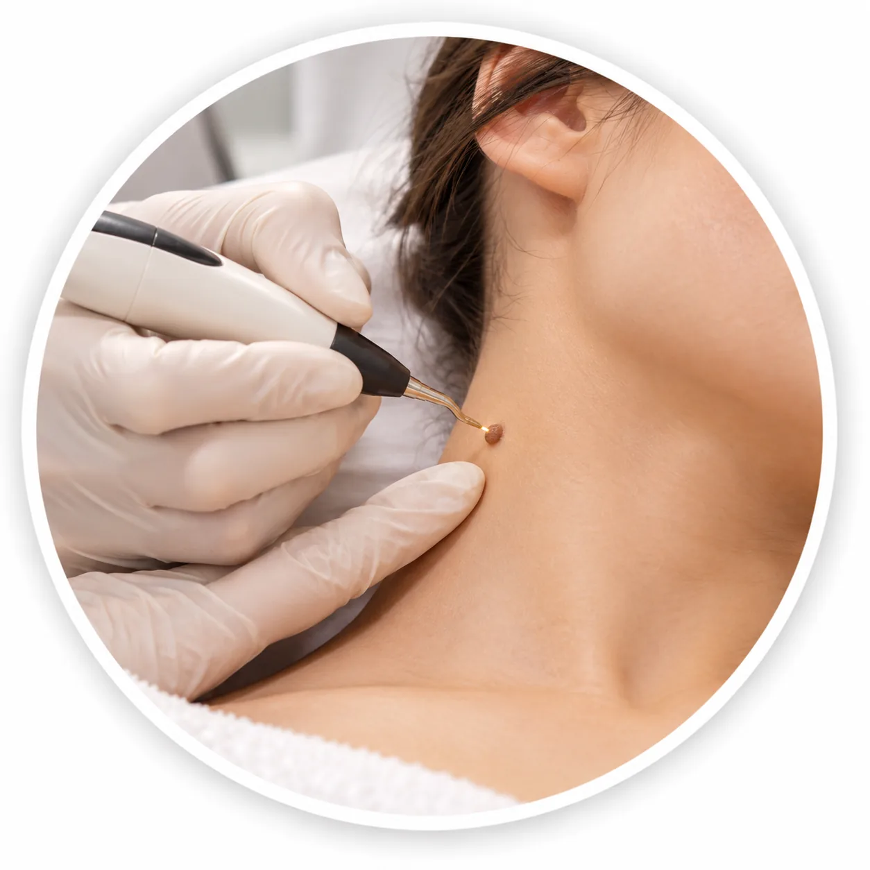 Mole & Skin Tag Removal