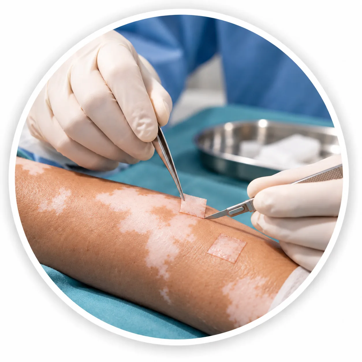 Vitiligo Surgery